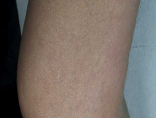 Vascular Laser Treatment - Ace Skin Health